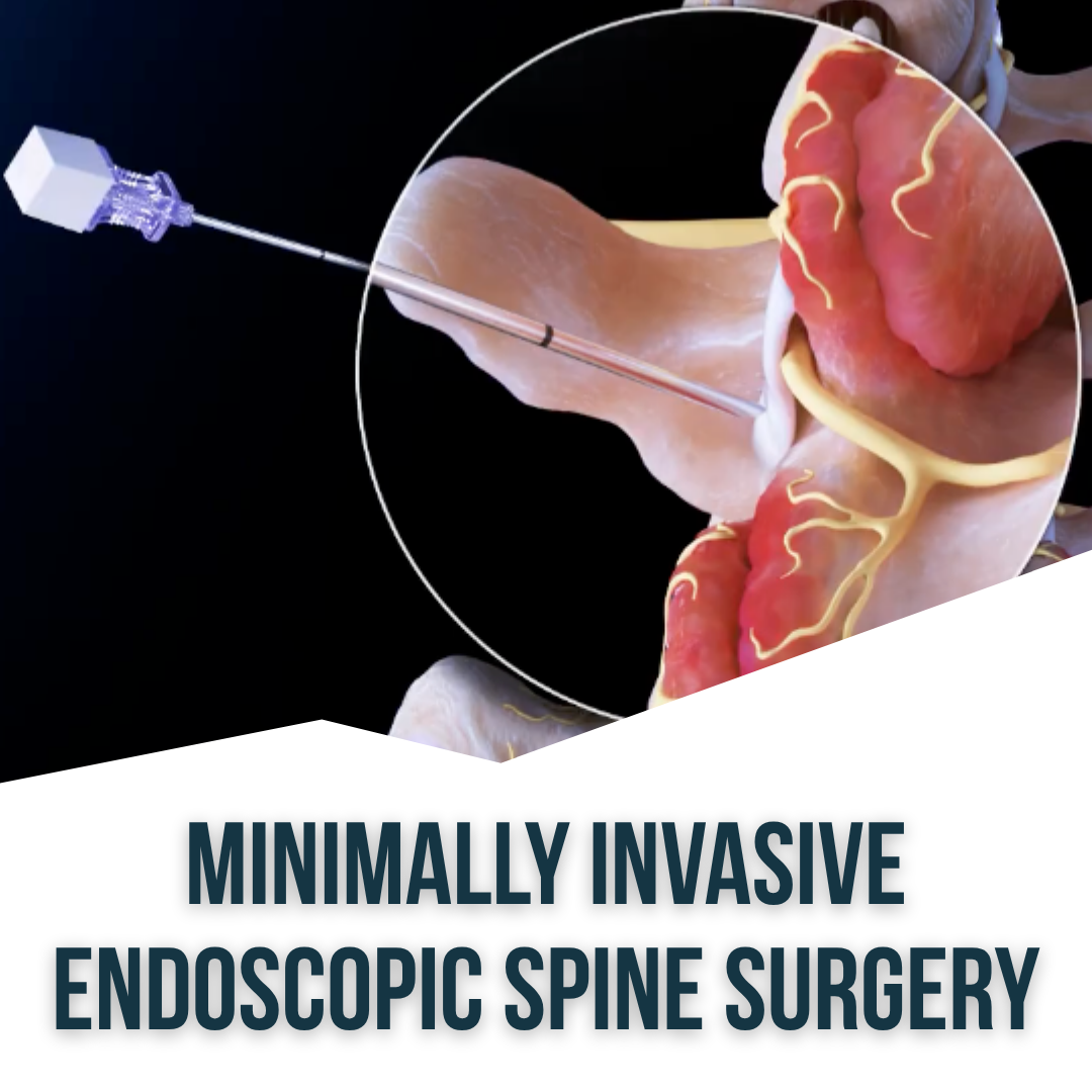 Endoscopic Spine Surgery: Minimally Invasive, Maximum Results